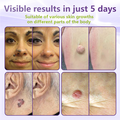 NESLEMY® Soluble Microneedle Botanical Skin Tag Removal Patch