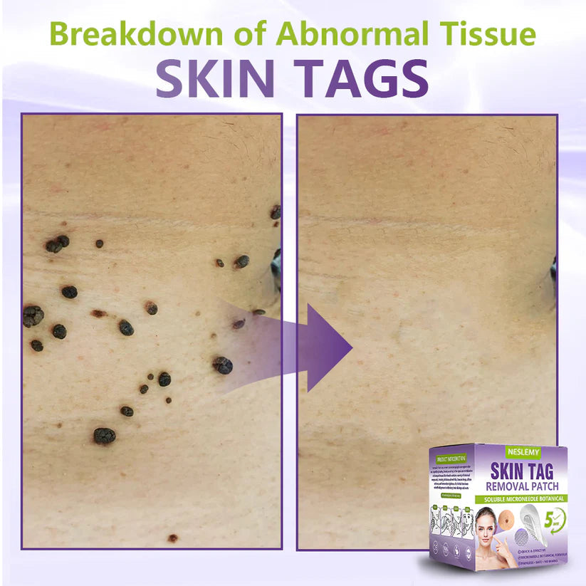 NESLEMY® Soluble Microneedle Botanical Skin Tag Removal Patch