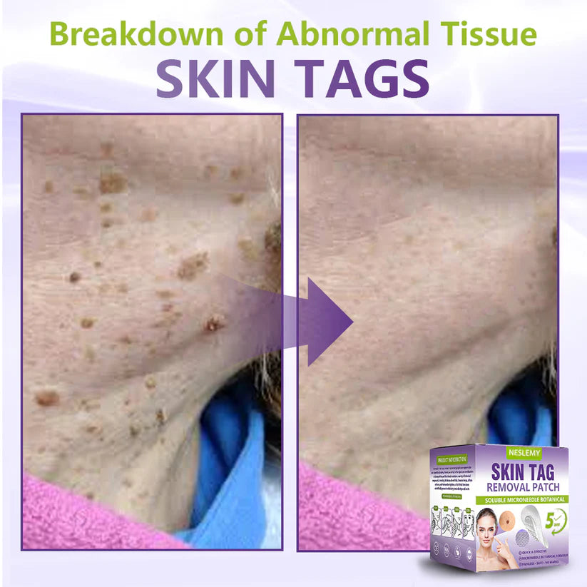 NESLEMY® Soluble Microneedle Botanical Skin Tag Removal Patch