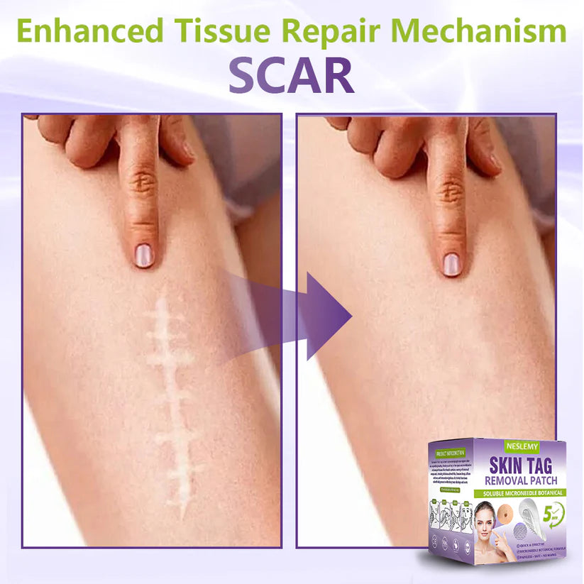 NESLEMY® Soluble Microneedle Botanical Skin Tag Removal Patch