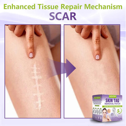 NESLEMY® Soluble Microneedle Botanical Skin Tag Removal Patch